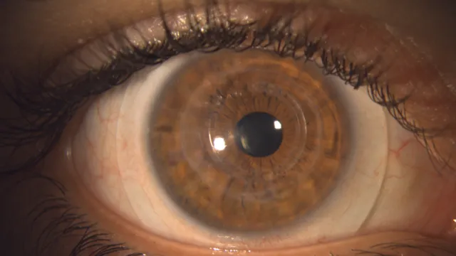 Corneal Transplant Contact Lenses: How Specialty Lenses Improve Vision After Surgery