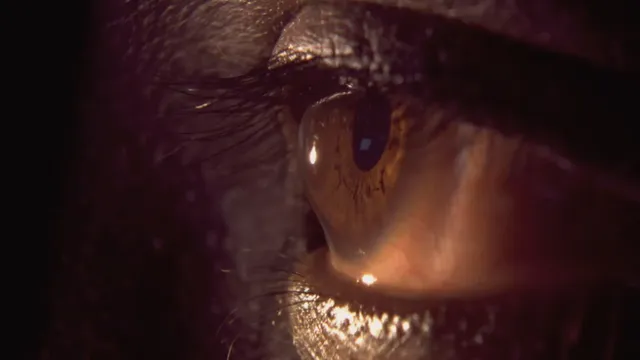 Keratoconus and Dry Eye: Understanding the Link