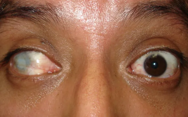 Before prosthetic contact lens fitting showing iris irregularity - Case 1
