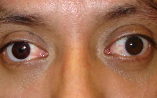 After prosthetic contact lens fitting with restored natural eye appearance - Case 1