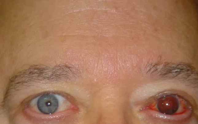 Before prosthetic contact lens fitting showing corneal scarring - Case 2