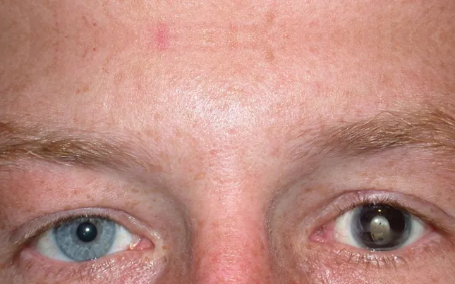 Before prosthetic contact lens fitting showing traumatic pupil deformity - Case 3