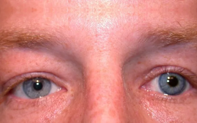 After prosthetic contact lens fitting with centered pupil and natural iris pattern - Case 3