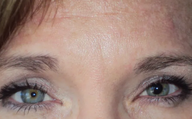 Before prosthetic contact lens fitting showing ocular trauma disfigurement - Case 4