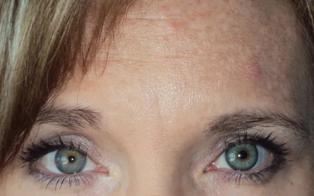 After prosthetic contact lens fitting with restored symmetry and aesthetic confidence - Case 4