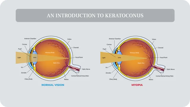 What is Keratoconus? (Keratoconus Eye Disease Explained)