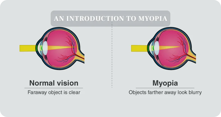 What Are MiSight Contact Lenses? video preview