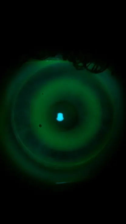Orthokeratology (Ortho-k) lenses