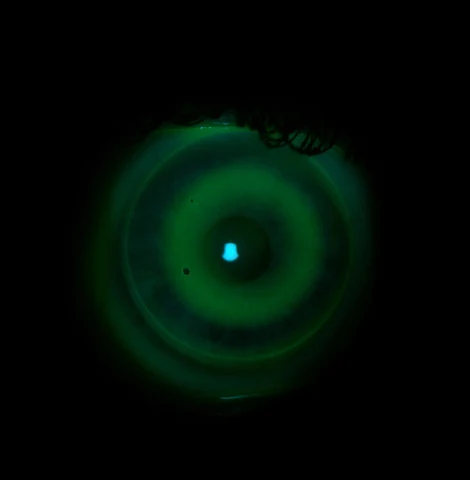 Fluorescein pattern of Ortho-k lens fit under cobalt blue light