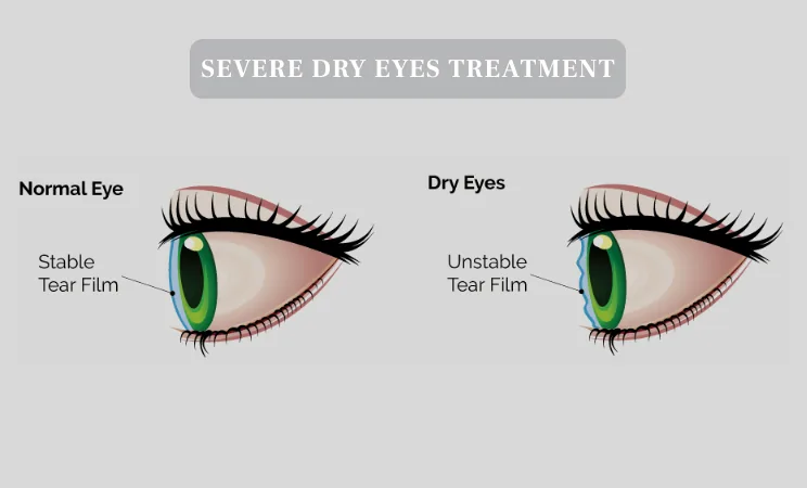Severe dry eye disease video presentation by Dr. Madison Moss