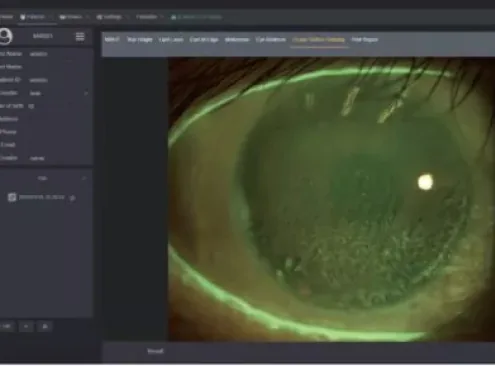 Corneal sodium fluorescein vital dye staining examination