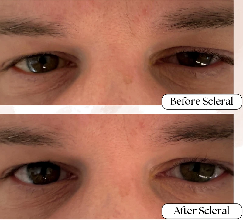 Before and after scleral contact lens comparison showing therapeutic relief