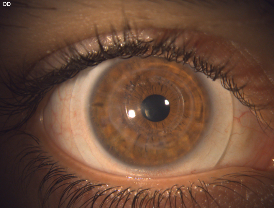 Corneal Transplant