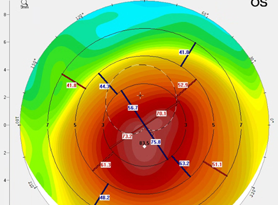 Focus on Keratoconus